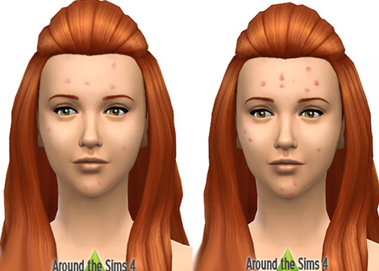 Zits, with Two Levels of Intensity / Sims 4 CC