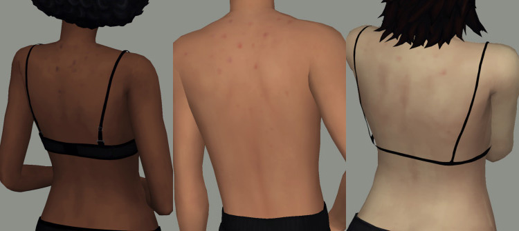 Best Sims 4 Acne Skin CC Details  All Free    FandomSpot - 66